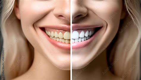 Yellow Teeth before and after whitening. Happy smiling woman ...