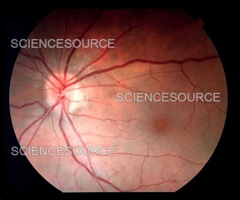 Photograph | Papilledema on Fundoscopy | Science Source Images