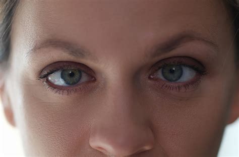 lazy eye    strabismus urban optique