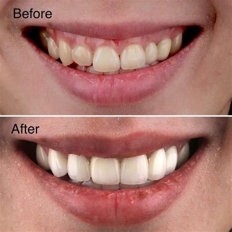 dental veneers  complete guide mydentist