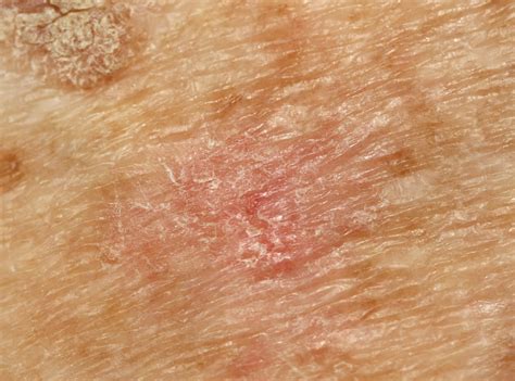 Aktinische Keratosen - Ursachen, Therapie und Vorbeugung