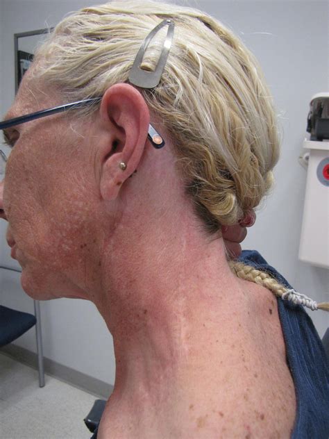Posterolateral Neck Dissection Positioning and Surgical Steps | Iowa