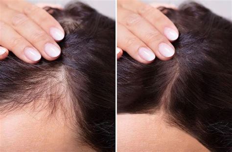 Мезотерапия волос - Exclusive Beauty Clinic. Kosmetický salon Praha