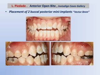 Anterior open bite treatment in the permanent dentition part 2- | PPT