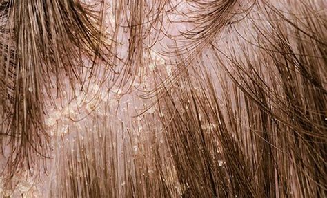 canh giac viem da dau  tre bi viem da