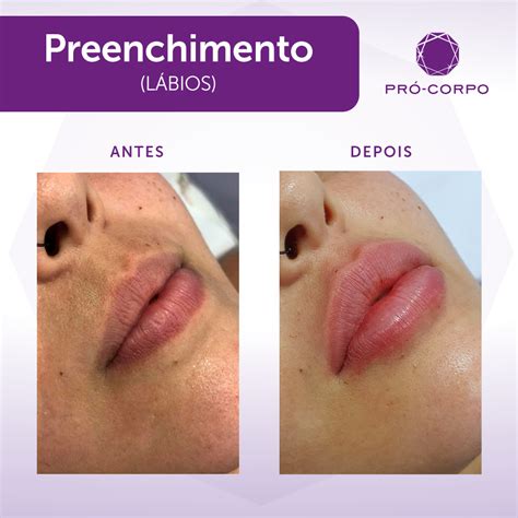 O Que É Preenchimento - Preenchimento Labial: Aumento dos lábios | Pró-Corpo
