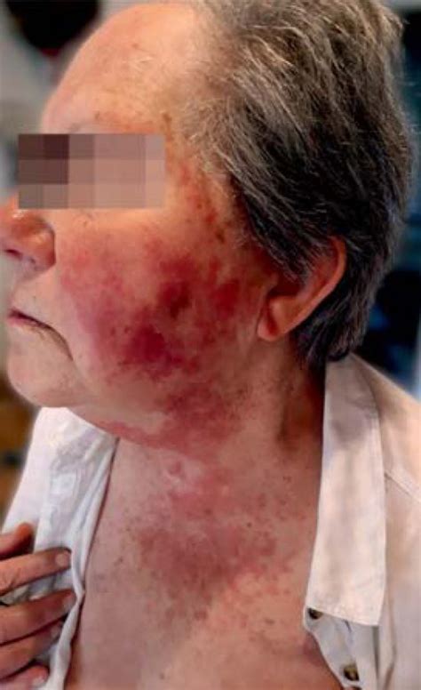 vancomycin flushing syndrome  oral administration