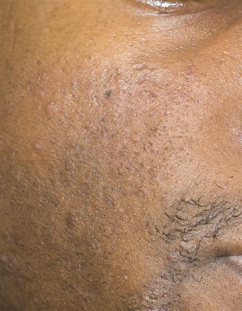 What laser for my scar and skin type – Scar treatments – Acne.org Forum