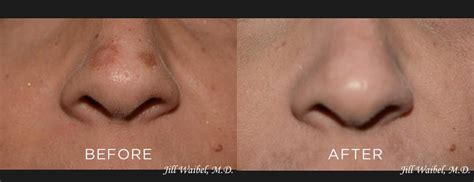 surgical scars miami dermatology laser institute