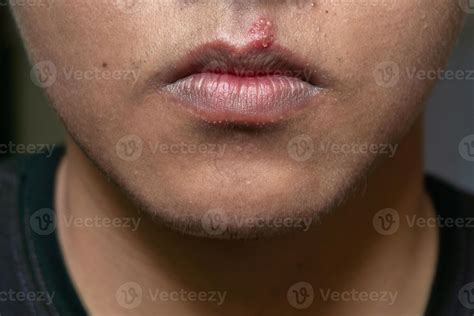 Herpes virus and infection treatment. Men lips affected by herpes