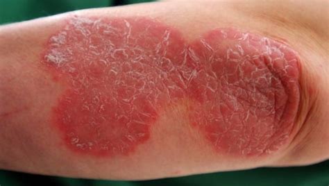 Psorijaza – uzroci, simptomi i liječenje | Kreni zdravo!