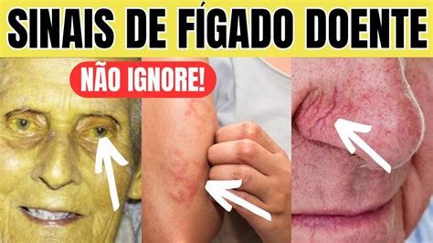 Cirrose Manchas Na Pele - Paciente Com Cirrose Hepatica