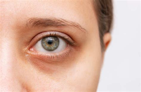 Do Eye Creams Work? Dr Davin Lim Dermatologist Explains