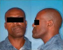 jaw dislocation  symptoms treatment mobile physio