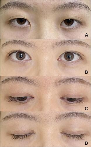 full article tarsus orbicularis septum fixation  double eyelid