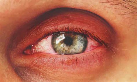Blepharitis Sore Itchy Red Eye Causes And Symptoms Causes,