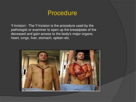autopsies powerpoint    id