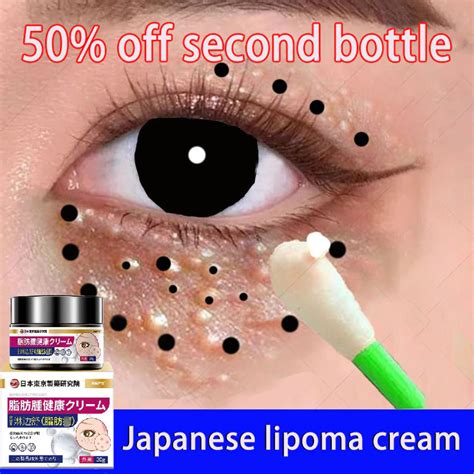 Japan Lipoma removal cream eye cream (𝐫𝐞𝐦𝐨𝐯𝐞 𝐥𝐢𝐩𝐨𝐦𝐚 𝐢𝐧 𝟕 𝐝𝐚𝐲𝐬) Lipoma ...