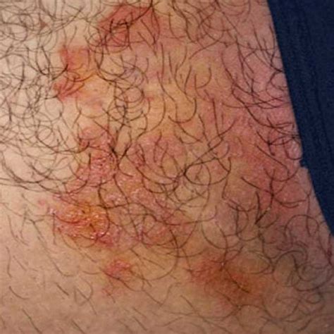 fungal infection  thigh