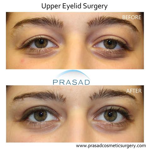 Blepharoplasty Before and After Photos | Prasad Cosmetic Surgery