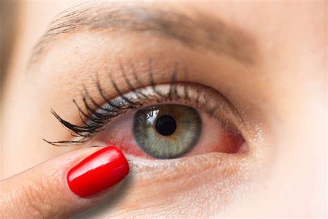 Konjuktivitis - Sve što Trebate Znati | Sani Oftalmologija