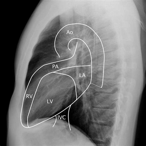 Chest anatomy - radiographs and CT - by Alexander Baxter