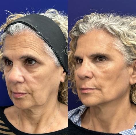 Revolutionary Transformation: El Protocolo Global Face del Dr. Ángel