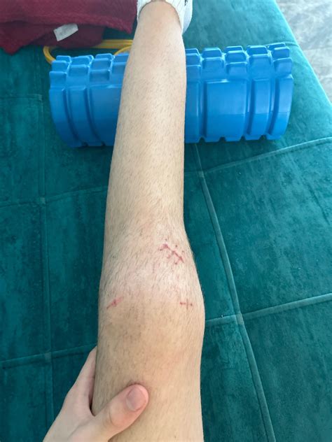 5 weeks post acl and meniscus surgery : r/ACL