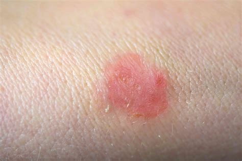Ringworm: Types, Symptoms, Causes, Diagnosis, Treatment and More
