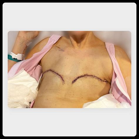 What It Looks Like: Double Mastectomy and Aesthetic Flat Closure