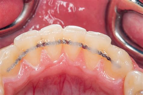 Retainers | Oxford Orthodontics