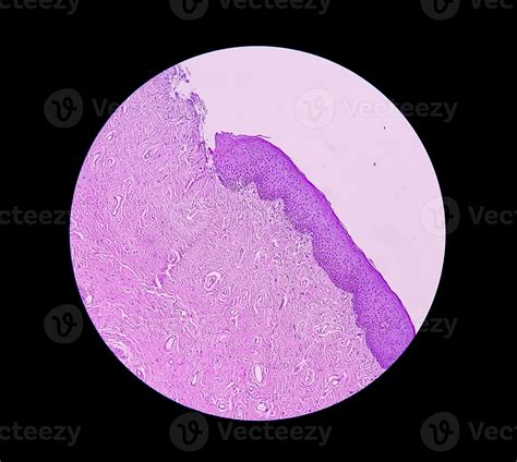Histological biopsy of Scrotal wall under microscopy showing Calcinosis