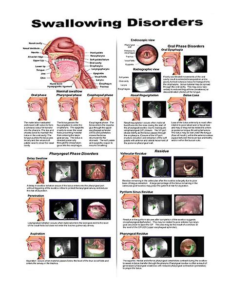 Ynb Throat Anatomy Poster Human Swallowing Disorders Anatomical Chart