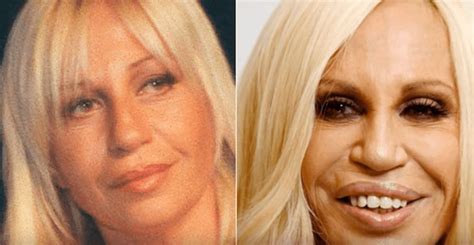 7 Celebrities Who Look Worse After Plastic Surgery - Cosmeticium