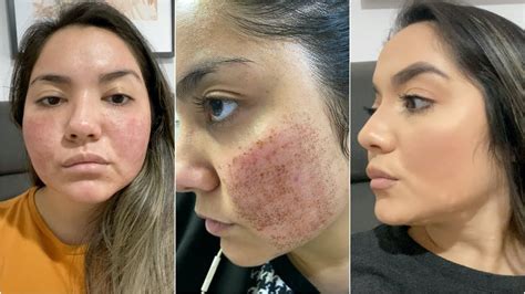 Bepantol No Rosto Antes E Depois - Bepantol Pos Laser Co2 - RETOEDU