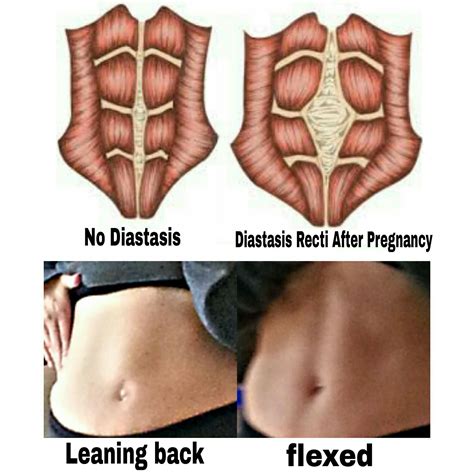 Postpartum Diastasis Recti – How it affects working out | Diastasis
