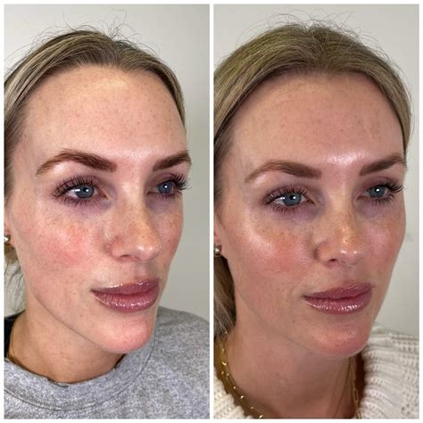 Skin Boosters Treatment In London | Revitalise Your Skin