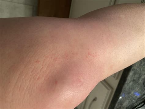 Derm says contact dermatitis. No idea how. **Have been to see two docs