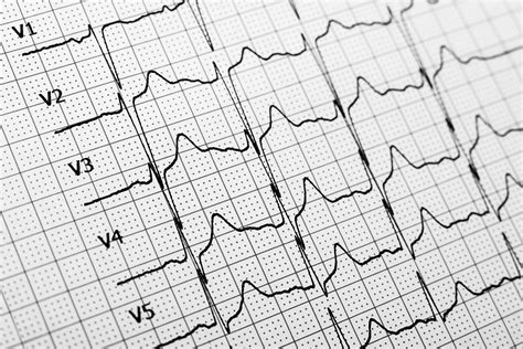 Seizure Symptoms: Early Signs of a Epileptic Seizure | The Healthy