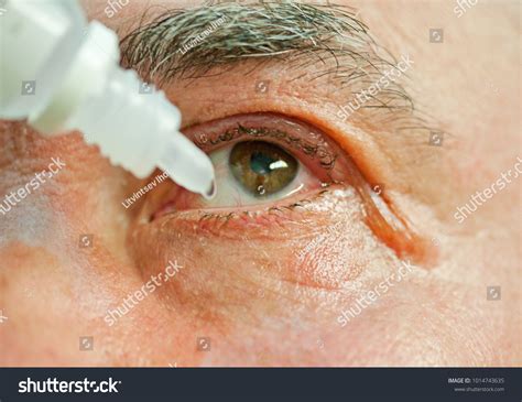 human swollen eyes diagnosis conjunctivitis instilled stock photo