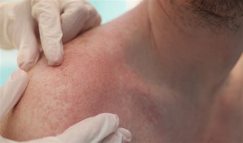 What To Know About Sun Rash - Advanced Dermatology Care