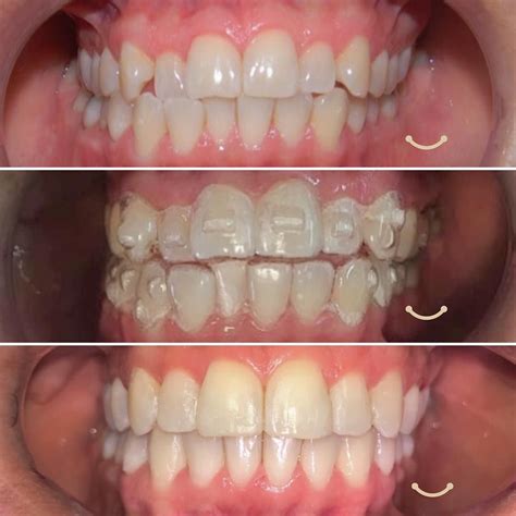 clear aligners  orthodontics invisalign orthodontics gum care
