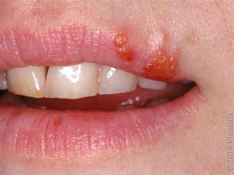 how to know if cold sore is herpes