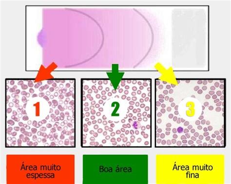 Contagem Diferencial De Leucocitos - Prática - Contagem diferencial de leucócitos | Biomedicina Padrão
